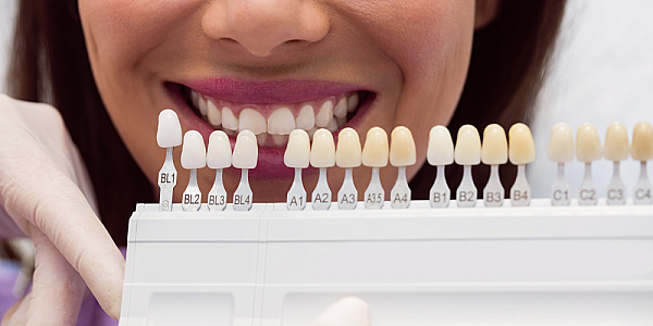 Dental veneers – a fad or a necessity