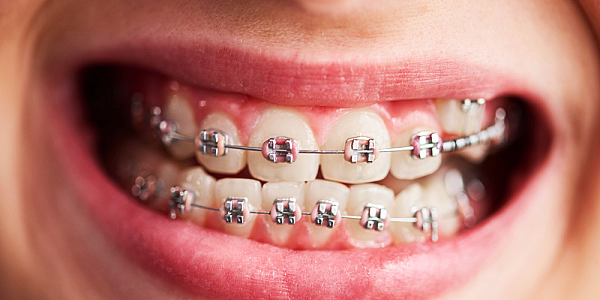 Cât costă un aparat dentar în 2023?