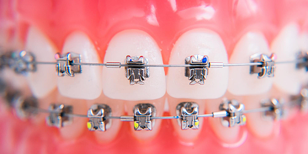 Ofertă Aparate Dentare Fixe