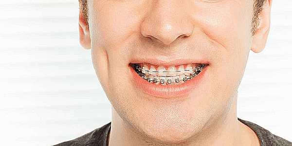 Aparatul dentar de safir – caracteristici și avantaje