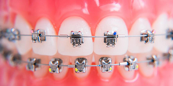 Offer Fixed Dental Braces