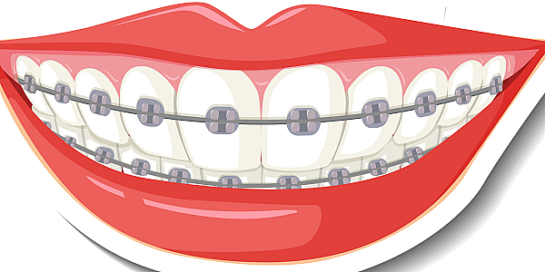 Complete guide about dental braces: types, costs, benefits