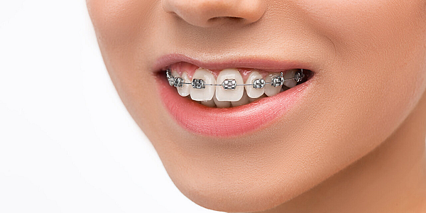 Dental Care with Braces: The Comprehensive Guide to Hygiene Rules for a Healthy Smile