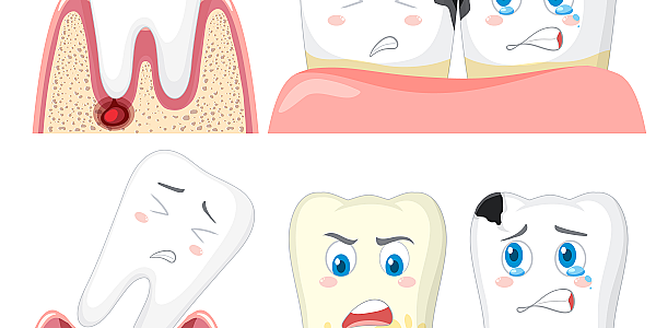 Everything you need to know about tooth decay and cosmetic dental fillings: prevention, treatment and care