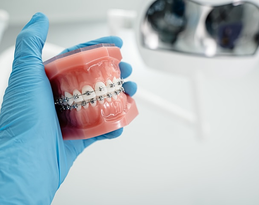 Aparat dentar metalic
