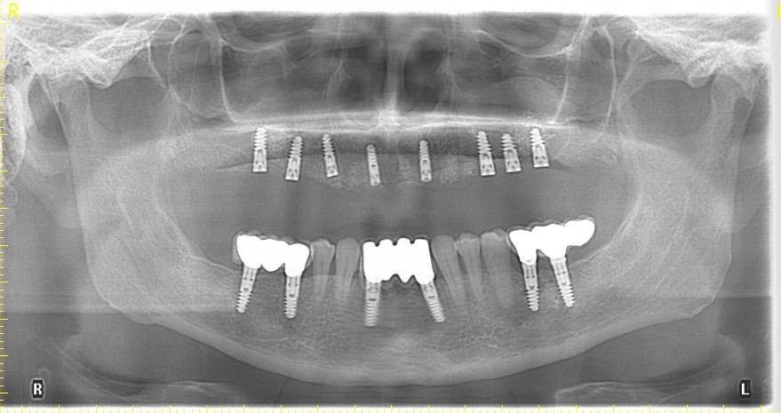 Alege serviciile stomatologice oferite de DentArbre. Vei cunoaște toate etapele tratamentului de la bun început, durata, costul total. În plus, îți oferim instrumente de plată precum plata în rate și costuri corecte pentru toate tratamentele stomatologice. De asemenea, poți consulta costurile online, pe pagina Prețuri.