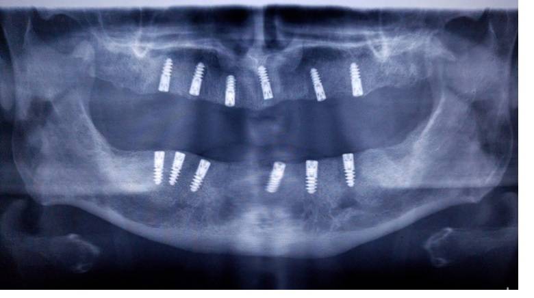 Choose the dental services offered by DentArbre. You will know all the stages of the treatment from the very beginning, the duration, the total cost. In addition, we offer you payment tools such as installment payments and fair costs for all dental treatments. You can also consult the costs online, on the Prices page.