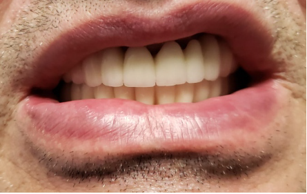 Alege serviciile stomatologice oferite de DentArbre. Vei cunoaște toate etapele tratamentului de la bun început, durata, costul total. În plus, îți oferim instrumente de plată precum plata în rate și costuri corecte pentru toate tratamentele stomatologice. De asemenea, poți consulta costurile online, pe pagina Prețuri.