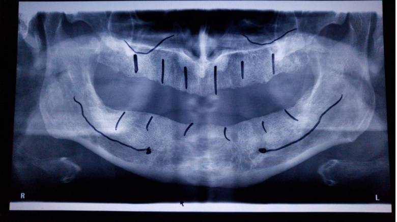 Choose the dental services offered by DentArbre. You will know all the stages of the treatment from the very beginning, the duration, the total cost. In addition, we offer you payment tools such as installment payments and fair costs for all dental treatments. You can also consult the costs online, on the Prices page.