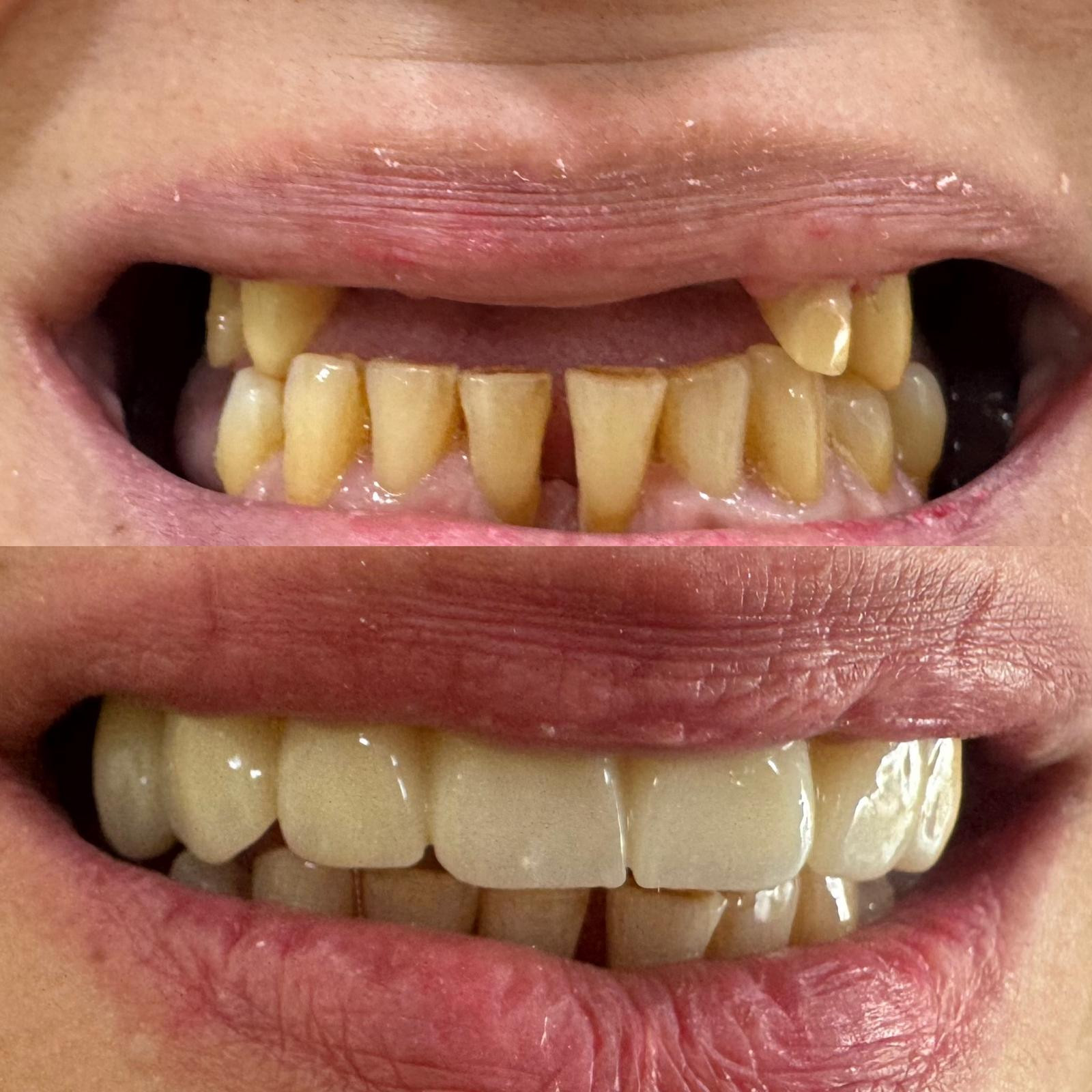 Before and after zirconium crowns