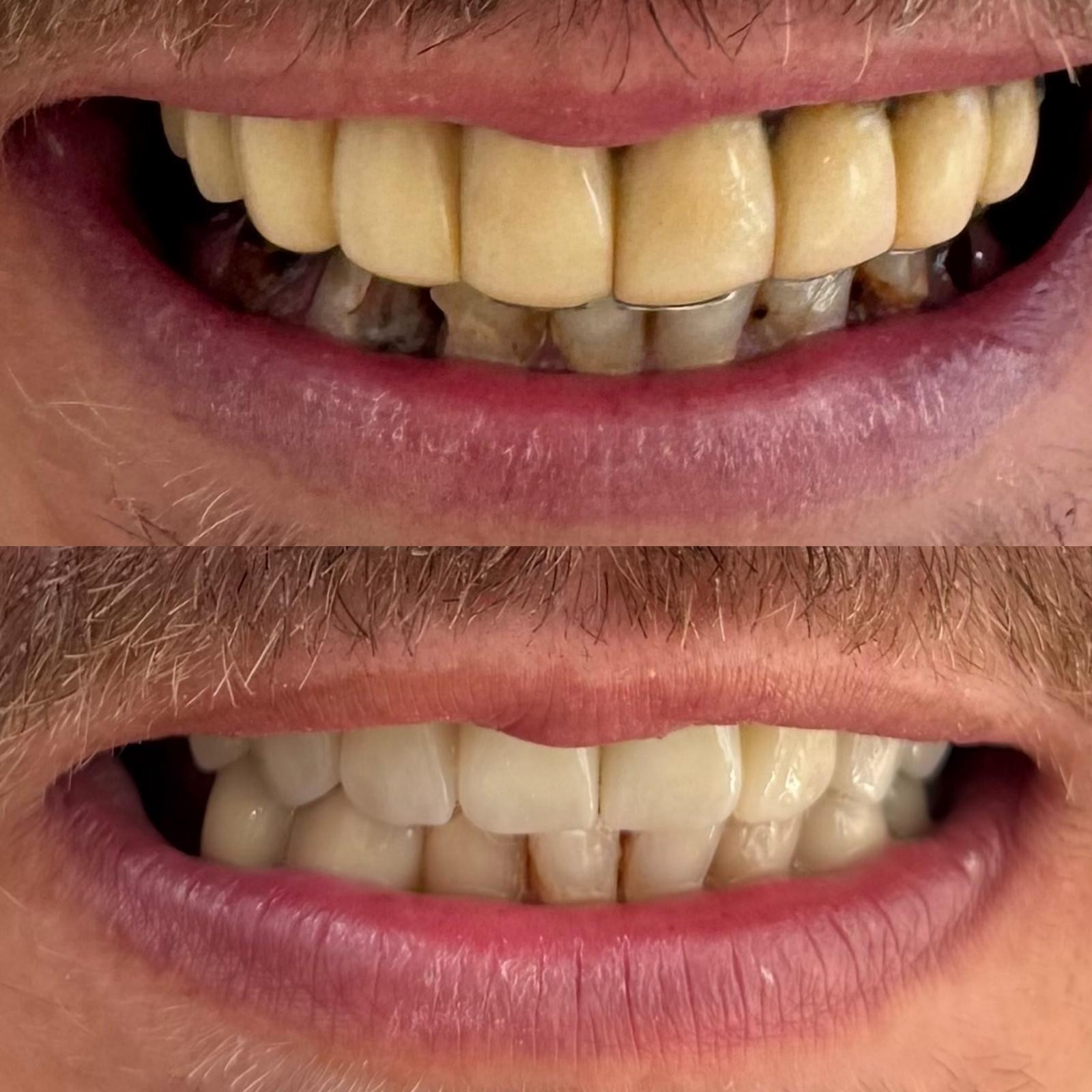 Before and after zirconium crowns