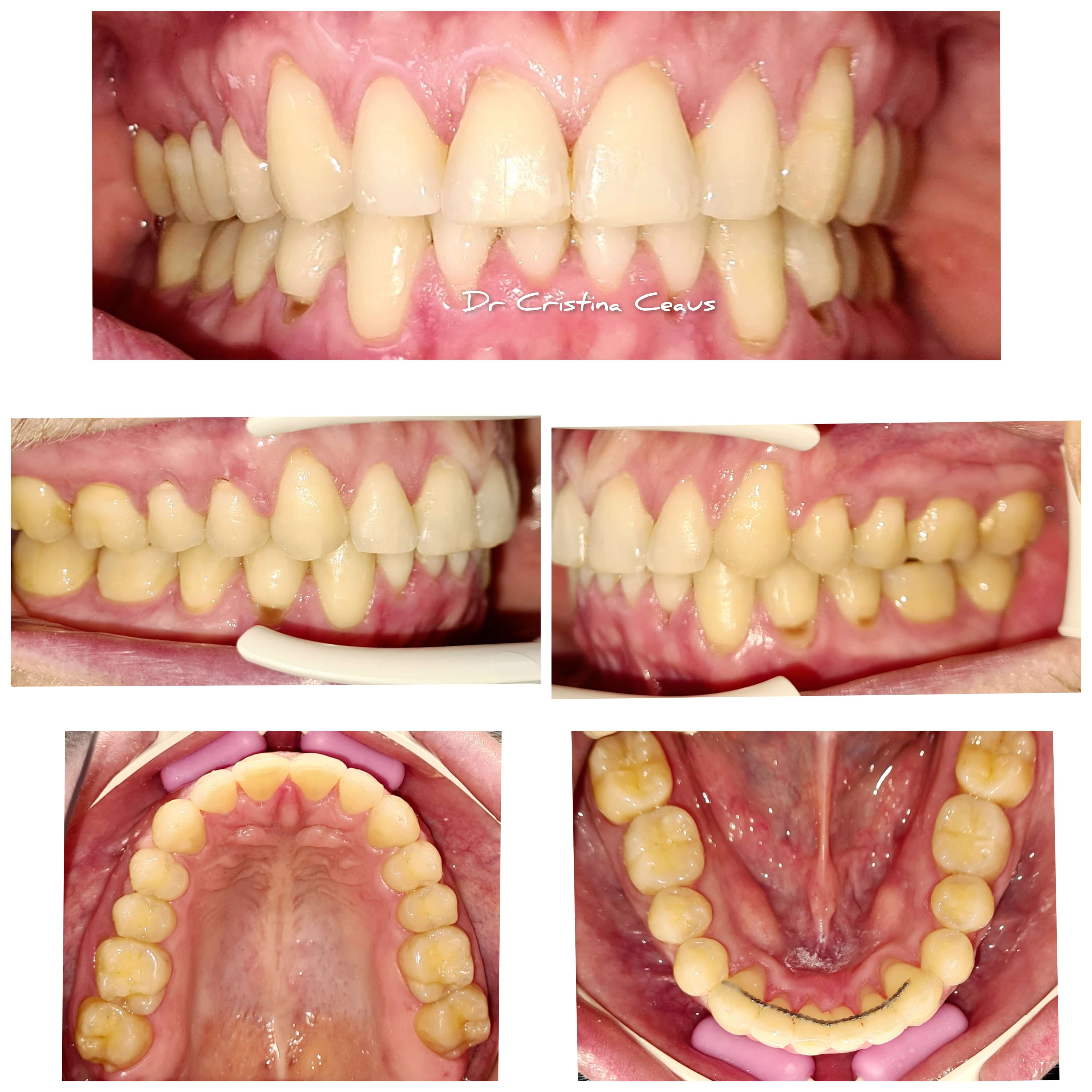 Alege serviciile stomatologice oferite de DentArbre. Vei cunoaște toate etapele tratamentului de la bun început, durata, costul total. În plus, îți oferim instrumente de plată precum plata în rate și costuri corecte pentru toate tratamentele stomatologice. De asemenea, poți consulta costurile online, pe pagina Prețuri.